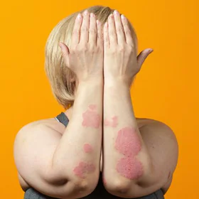 Luskavica (psoriaza)- kaj je in kakšni so simptomi