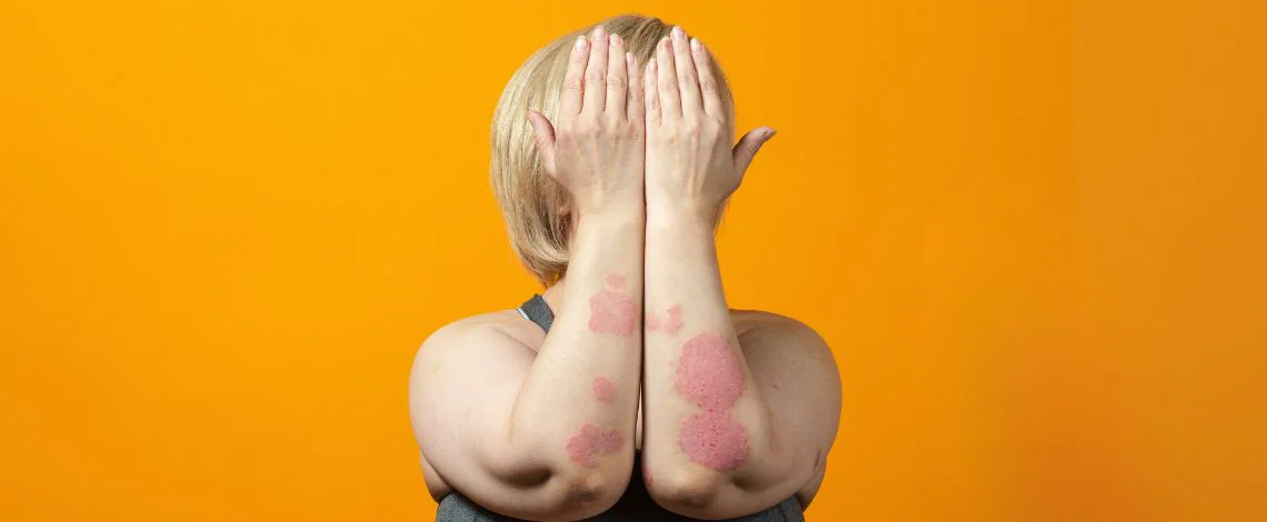 Luskavica (psoriaza)- kaj je in kakšni so simptomi