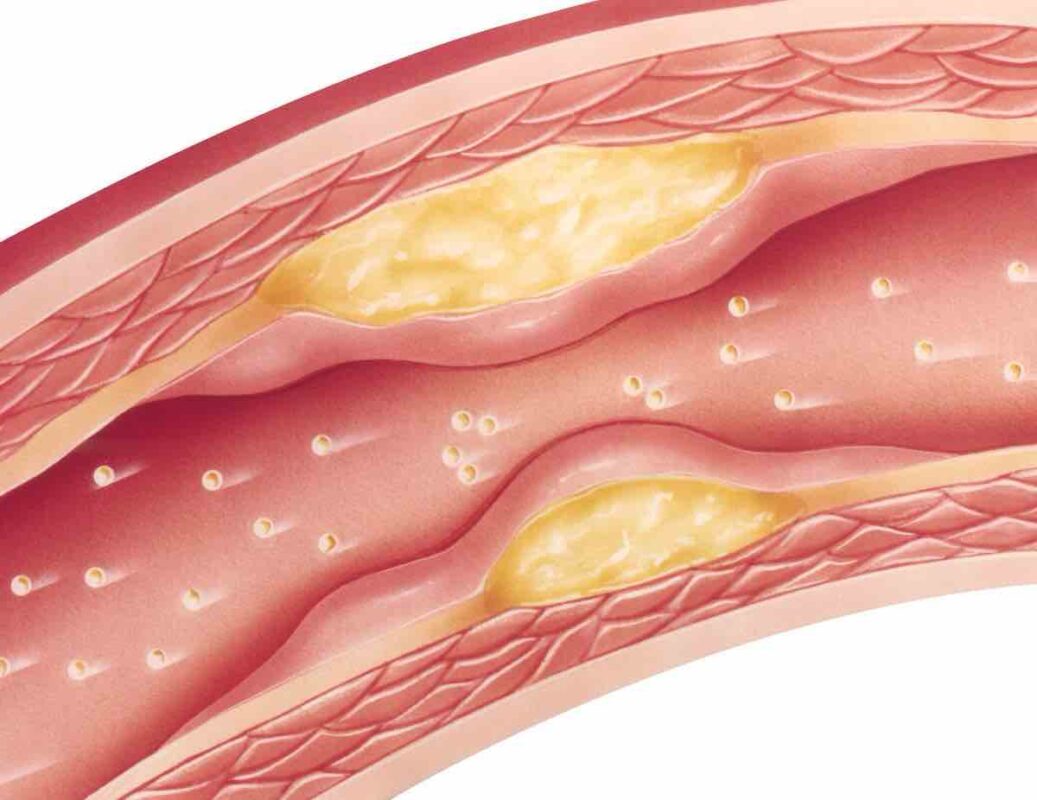 ateroskleroza-zaradi-ldl-holesterola