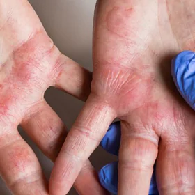 atopijski-dermatitis-kaj-je