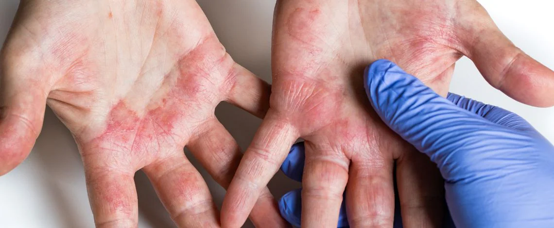 atopijski-dermatitis-kaj-je