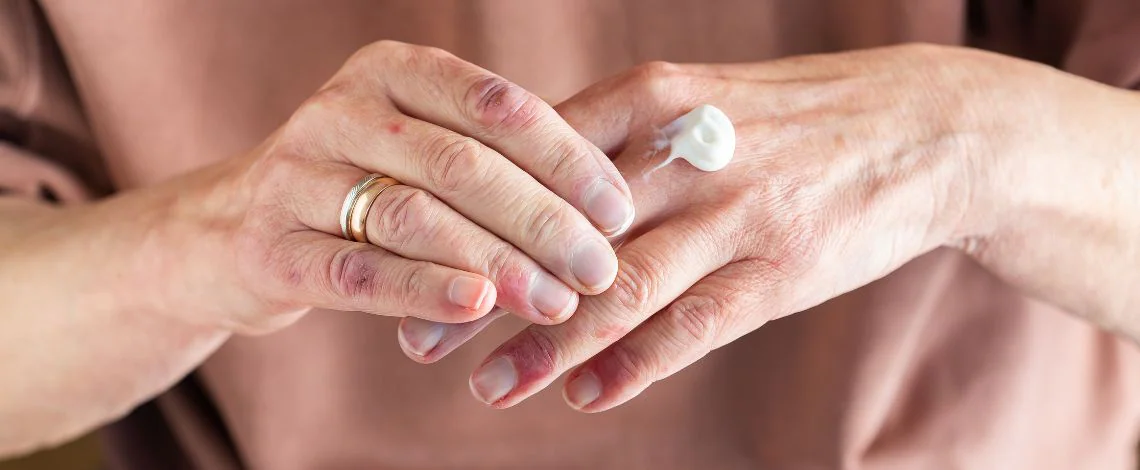 atopijski-dermatitis-pri-odraslih