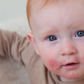 atopijski-dermatitis-pri-otrocih