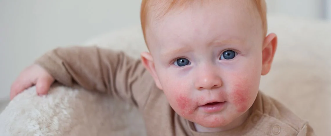 atopijski-dermatitis-pri-otrocih