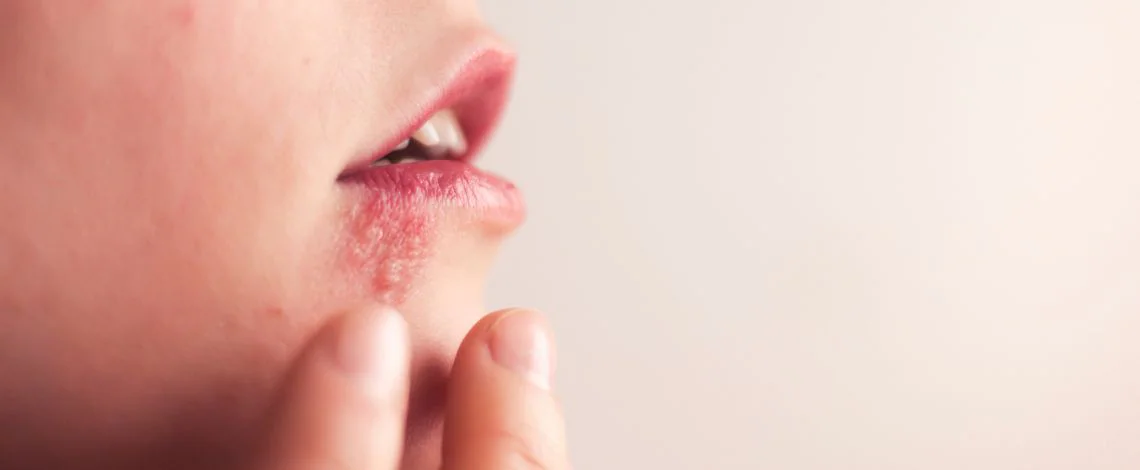 herpes-na-ustnici.jpg