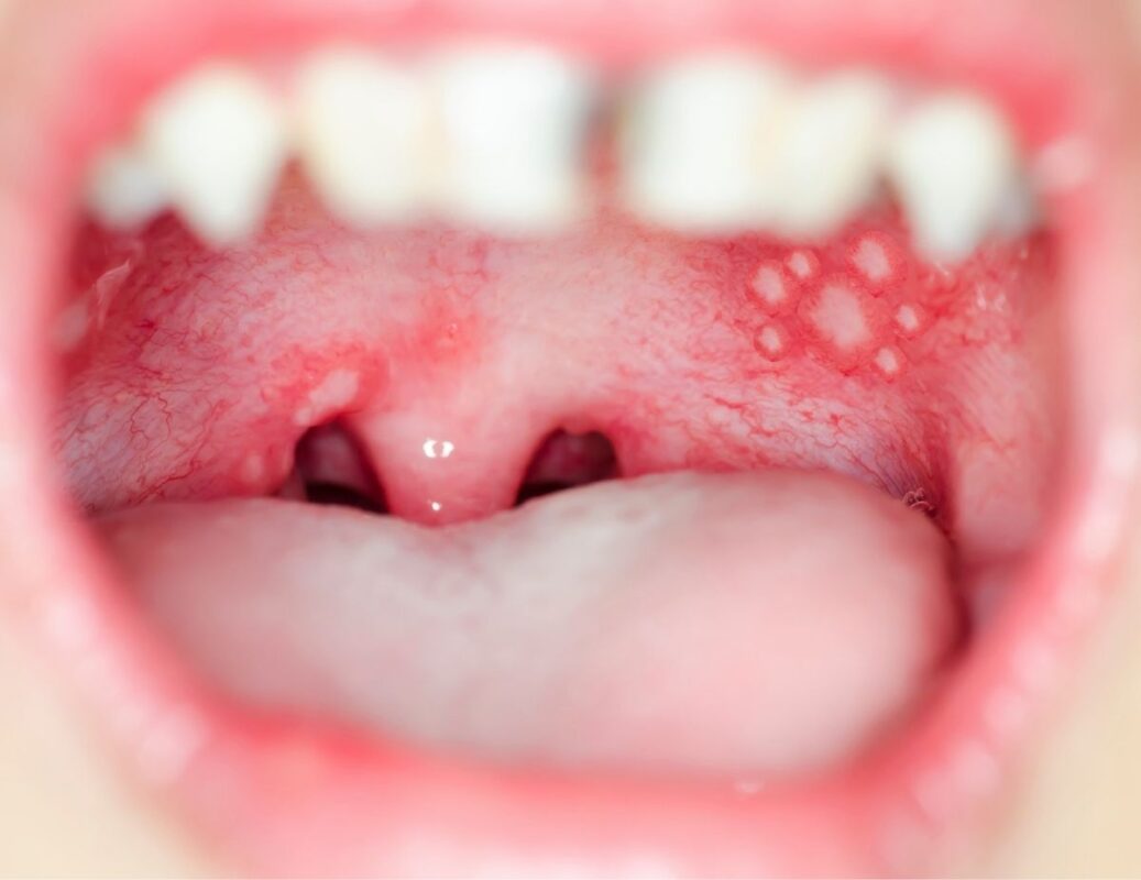 herpetiformne-afte