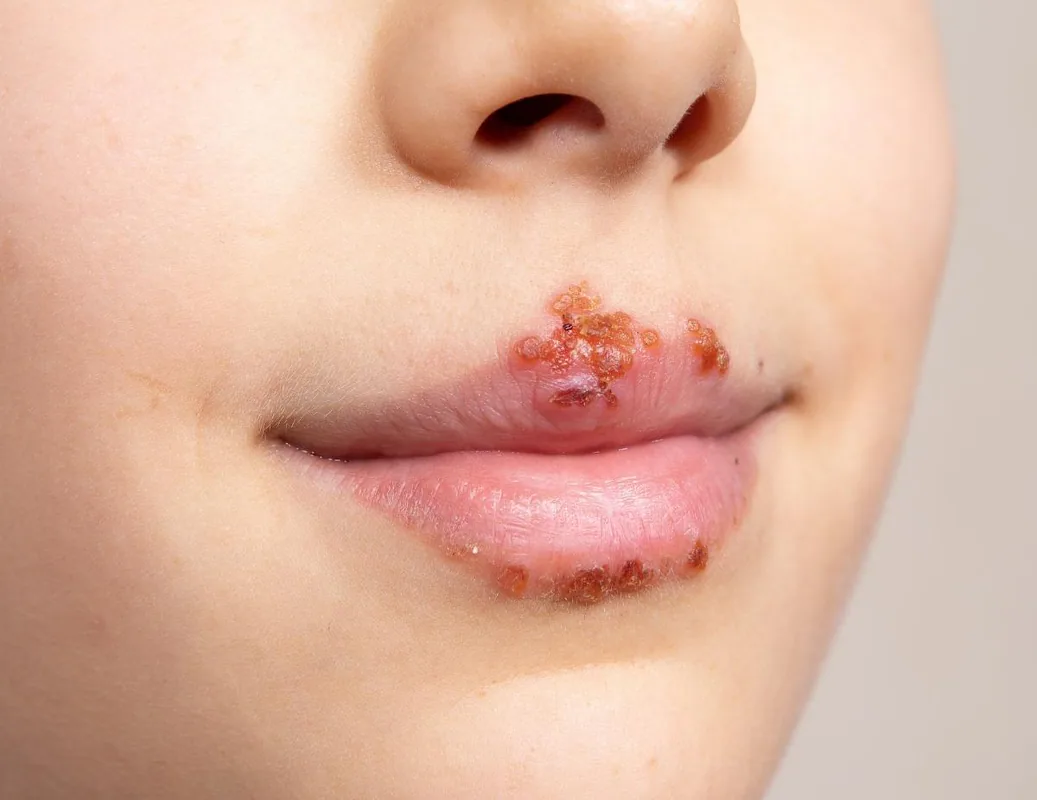 izgled-herpes-simplex-herpesa-na-ustnici