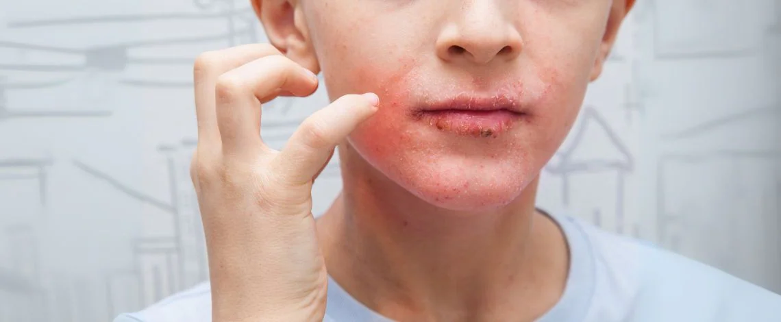psoriaza-pri-otrocih